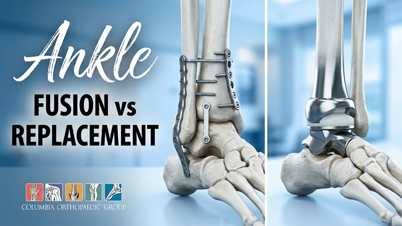 Ankle Arthritis: Modern Treatment Options to Keep You Moving