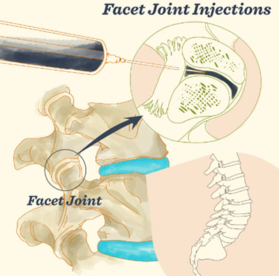 Living With Chronic Pain - Now Nearly Pain Free