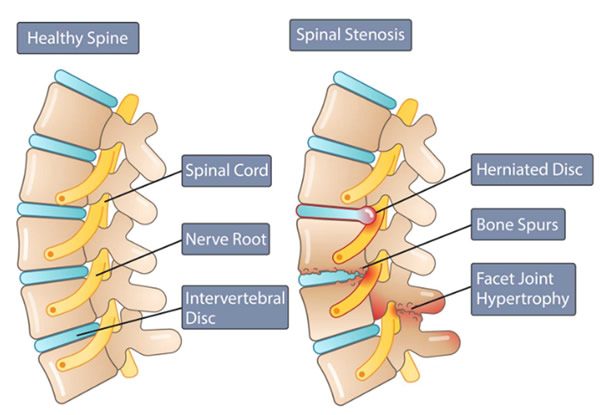 Lumbar Spinal Stenosis