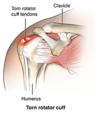 Rotator Cuff Tears