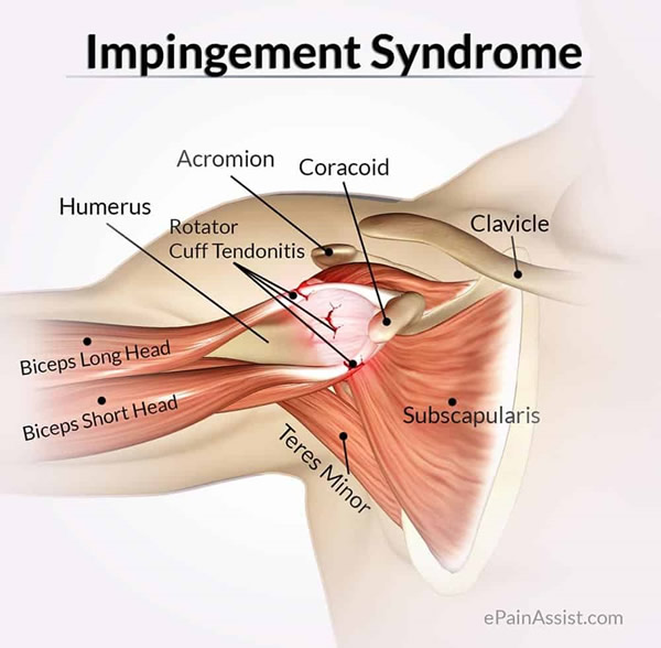 Shoulder impingement